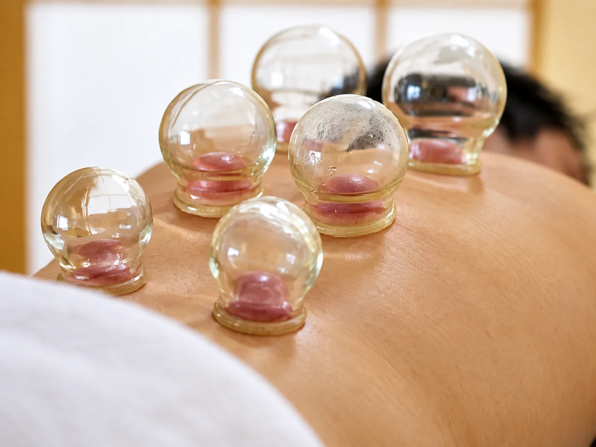 Cupping therapy with glass cups placed on the back
